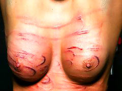 Bruised breast